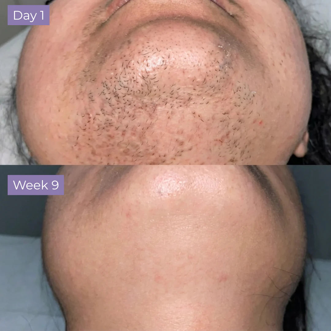 Cyperus Rotundus Serum
